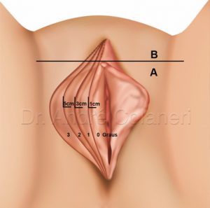 Classificação da Hipertrofia dos Pequenos Lábios Vaginais
